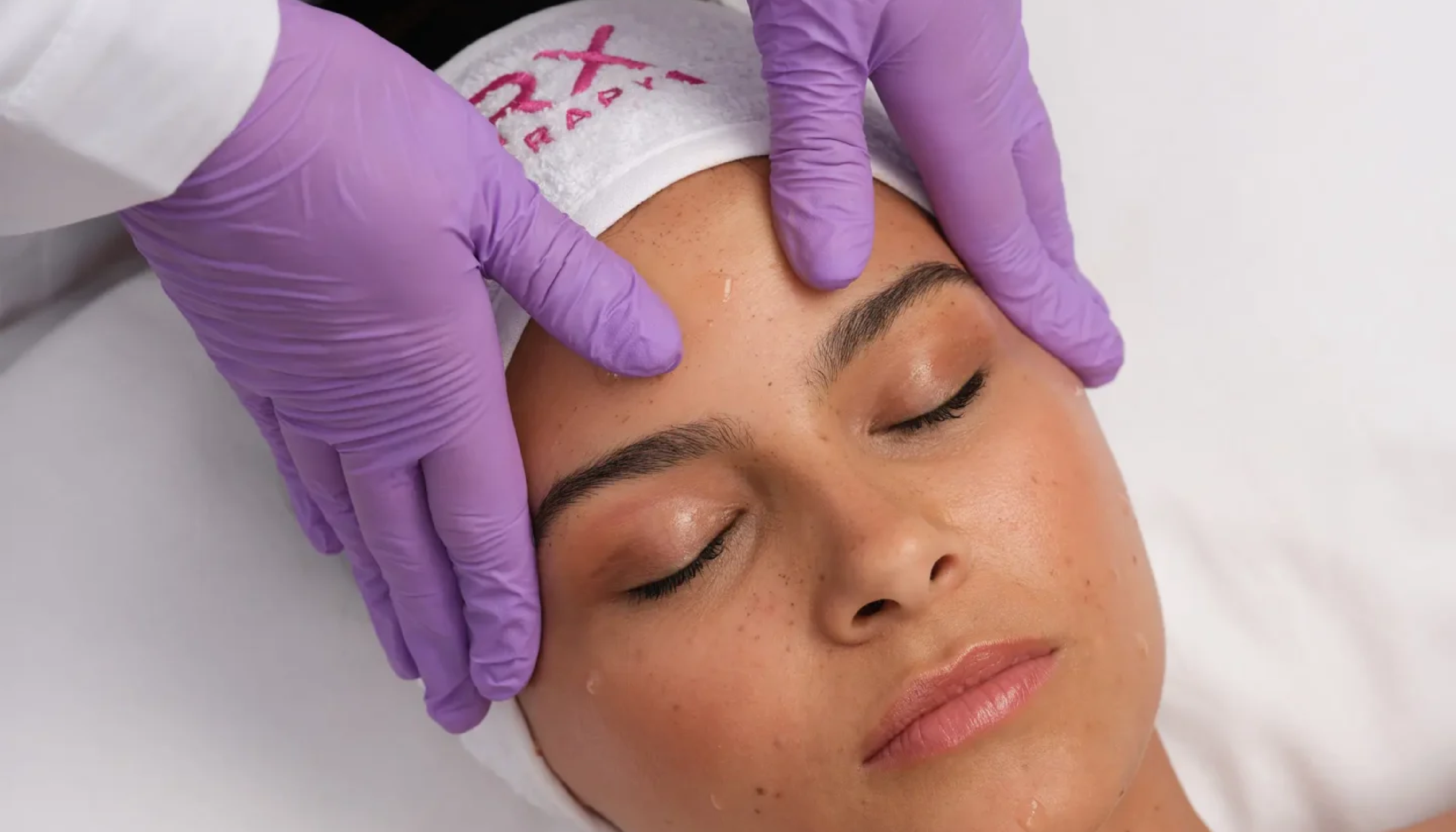 peeling-prxt-medicalgroup-alyamed-medicina-estetica-garbagnate